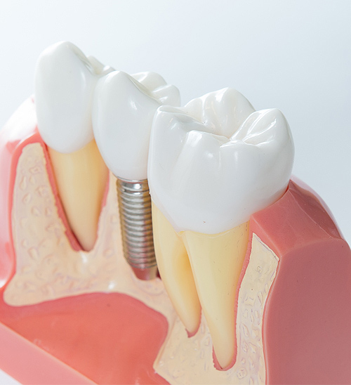 Dental Implants | Lara Village Dental