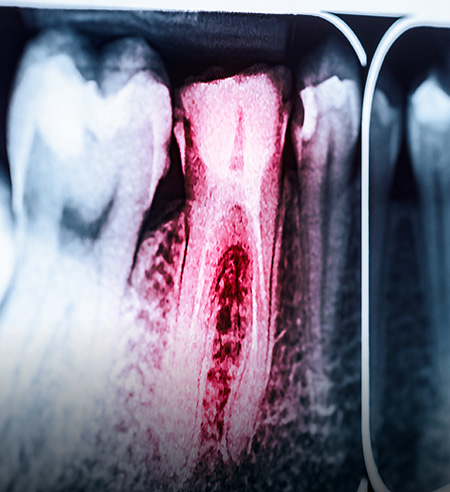 Root Canal Treatment | Lara Village Dental