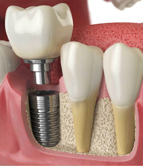 Dental Implants | Lara Village Dental