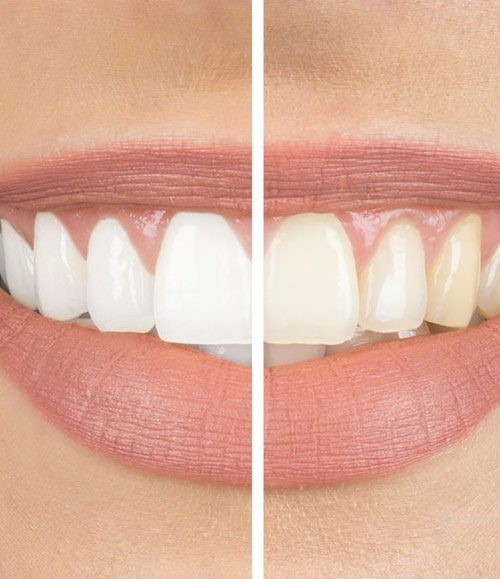 whitening | Lara Village Dental