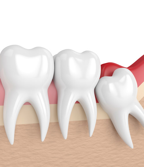 Wisdoms teeth removal | Lara Village Dental