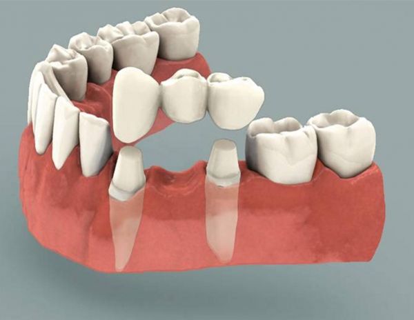 Dental Bridge | Lara Village Dental