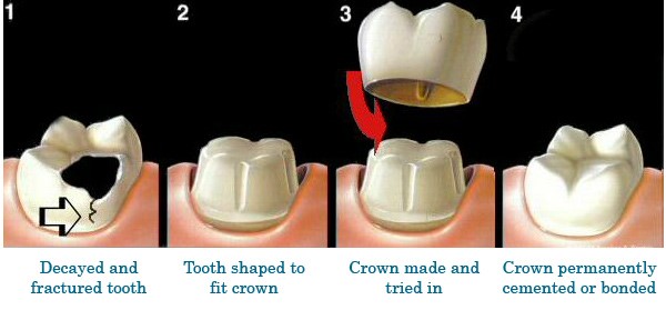 Dental Crown | Lara Village Dental