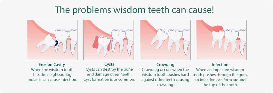 wisdom teeth 3 | Lara Village Dental