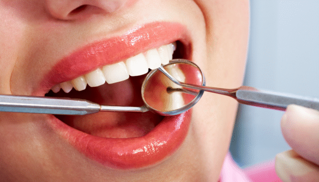 dental-bonding-lara-village-dental